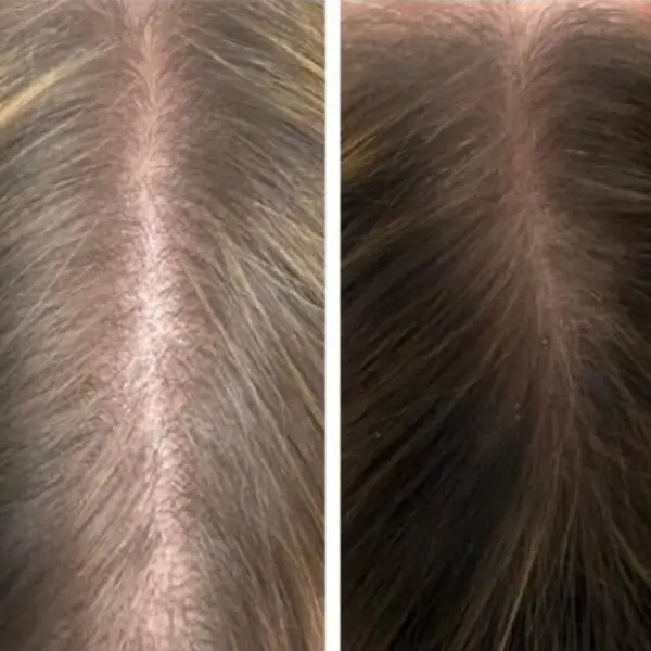 Hair rejuvenation By Dr Raghda