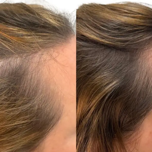 Hair rejuvenation By Dr Raghda