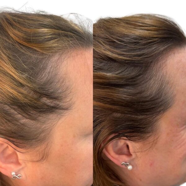 Hair rejuvenation by Dr Raghda