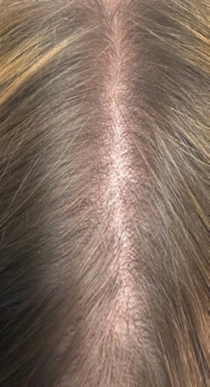 Crown and parting before treatment