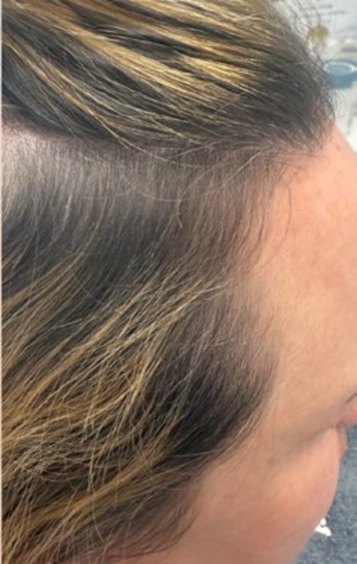 Frontal hairline after treatment