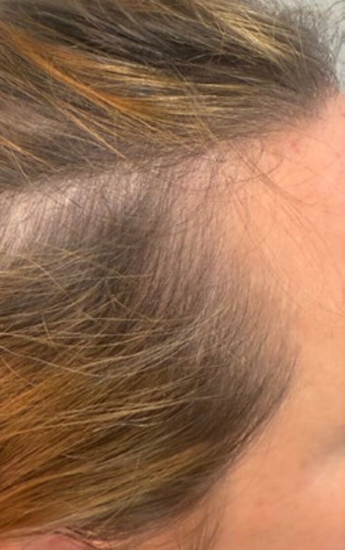Frontal hairline before treatment