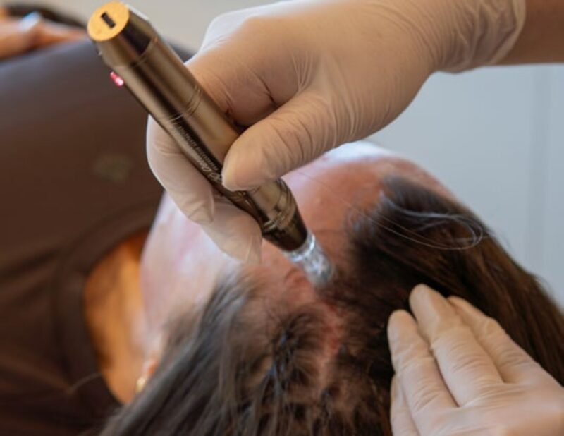 Microneedling-assisted scalp treatment